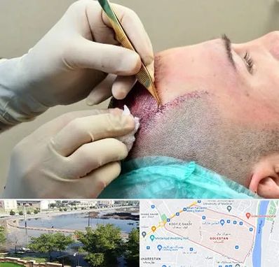 کلینیک کاشت مو در گلستان اهواز