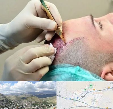 کلینیک کاشت مو در رودهن