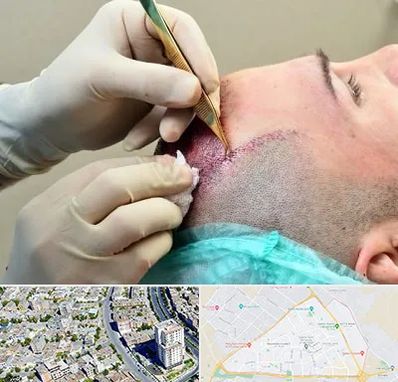 کلینیک کاشت مو در قاسم آباد مشهد