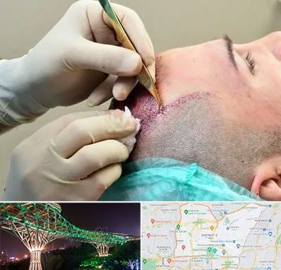 کلینیک کاشت مو در منطقه 3 تهران