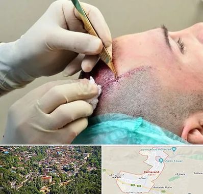 کلینیک کاشت مو در دماوند