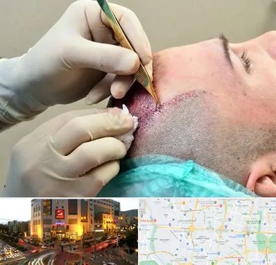 کلینیک کاشت مو در جنت آباد تهران