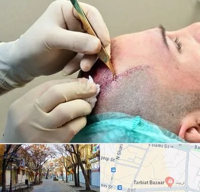 کلینیک کاشت مو در تربیت تبریز