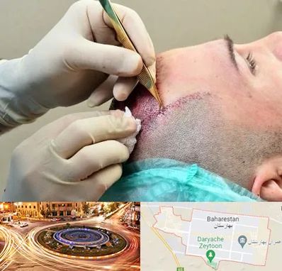 کلینیک کاشت مو در بهارستان