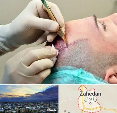 کلینیک کاشت مو در زاهدان