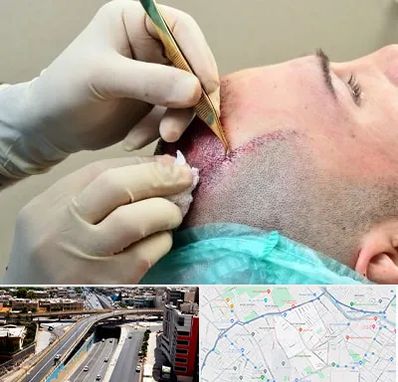 کلینیک کاشت مو در ستارخان شیراز