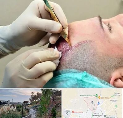 کلینیک کاشت مو در باغستان کرج