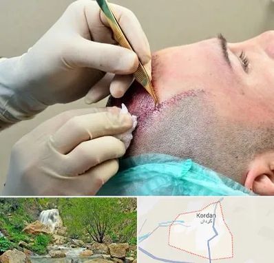 کلینیک کاشت مو در کردان