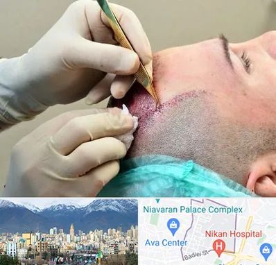 کلینیک کاشت مو در آجودانیه