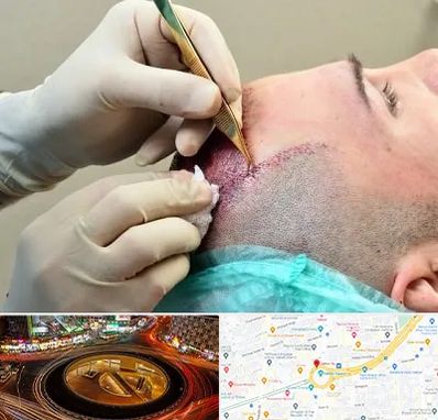 کلینیک کاشت مو در میدان ولیعصر