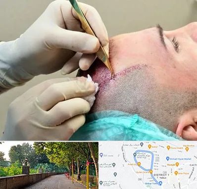 کلینیک کاشت مو در بلوار گیلان رشت