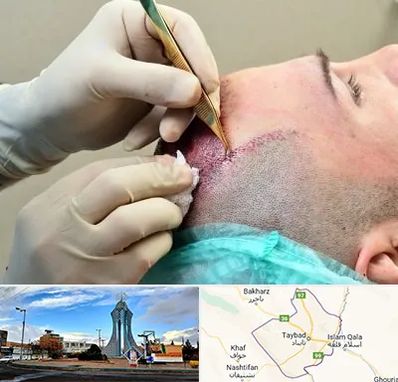 کلینیک کاشت مو در تایباد