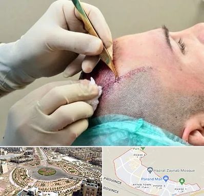 کلینیک کاشت مو در پرند