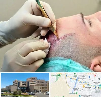 کلینیک کاشت مو در صیاد شیرازی مشهد