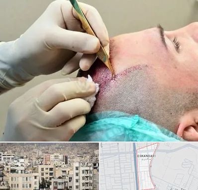 کلینیک کاشت مو در اسکندری