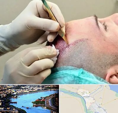 کلینیک کاشت مو در خرمشهر