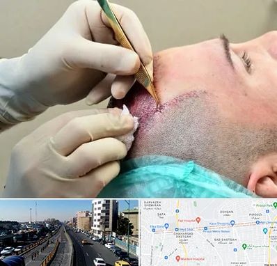 کلینیک کاشت مو در پیروزی