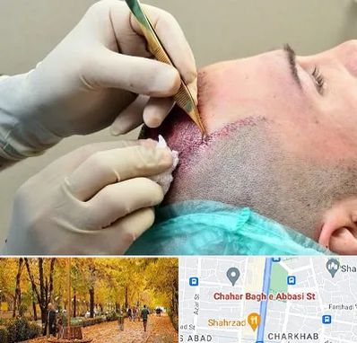 کلینیک کاشت مو در چهارباغ اصفهان