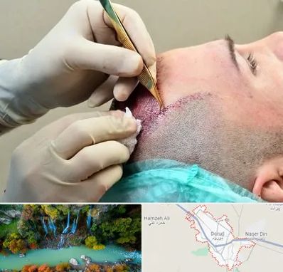 کلینیک کاشت مو در دورود