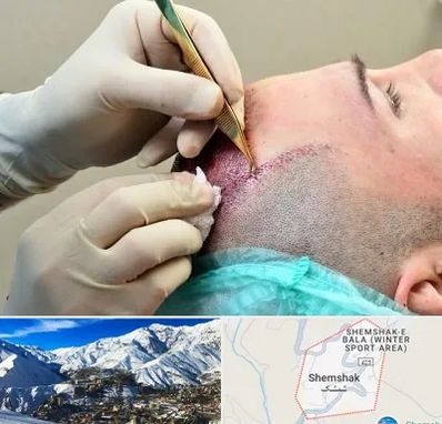 کلینیک کاشت مو در شمشک