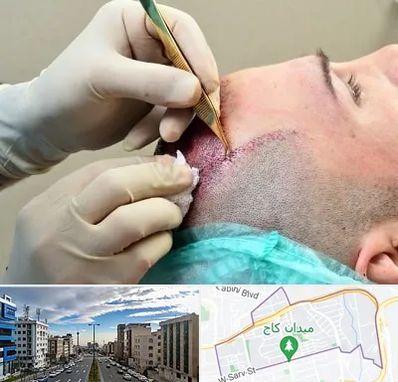 کلینیک کاشت مو در سعادت آباد