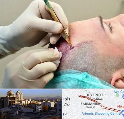 کلینیک کاشت مو در فرمانیه