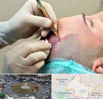 کلینیک کاشت مو در فردیس کرج