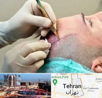 کلینیک کاشت مو در صادقیه