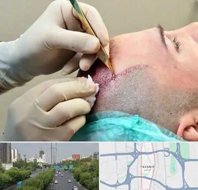 کلینیک کاشت مو در توانیر