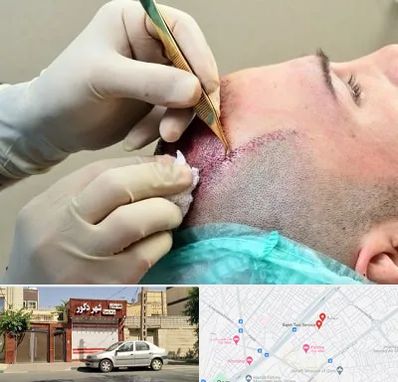 کلینیک کاشت مو در باجک قم