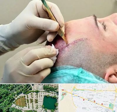 کلینیک کاشت مو در وکیل آباد مشهد