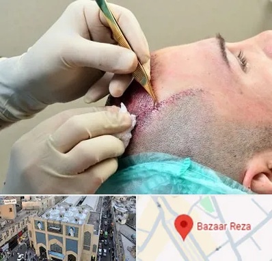 کلینیک کاشت مو در بازار رضا مشهد