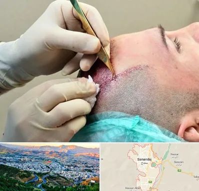 کلینیک کاشت مو در سنندج