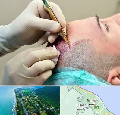کلینیک کاشت مو در رامسر