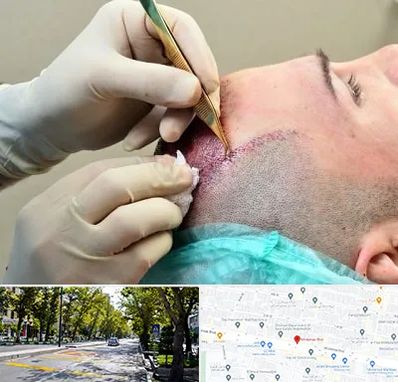 کلینیک کاشت مو در میرداماد