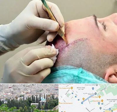 کلینیک کاشت مو در محلاتی شیراز