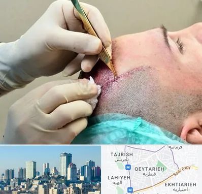 کلینیک کاشت مو در قیطریه