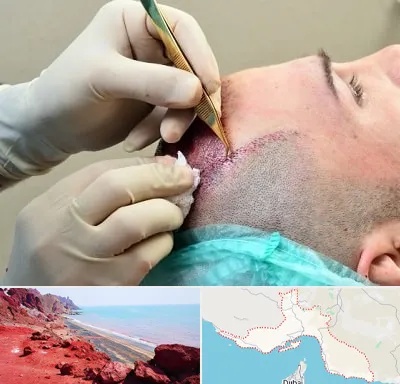 کلینیک کاشت مو در هرمزگان