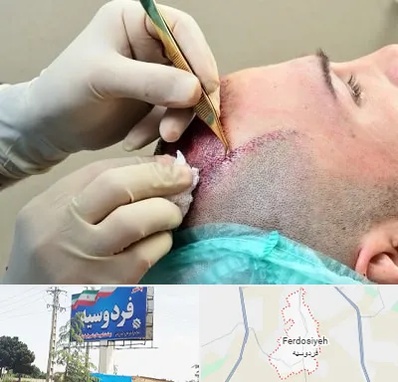 کلینیک کاشت مو در فردوسیه شهریار