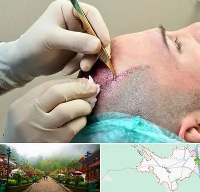 کلینیک کاشت مو در فومن