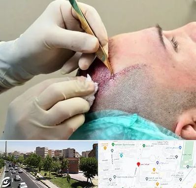 کلینیک کاشت مو در شهرک آزمایش