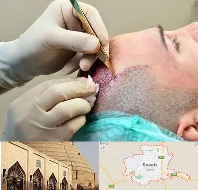 کلینیک کاشت مو در ساوه