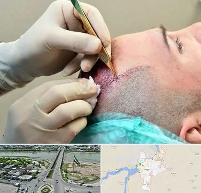 کلینیک کاشت مو در میاندوآب