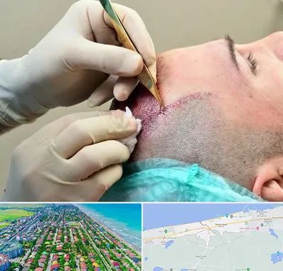 کلینیک کاشت مو در فریدونکنار