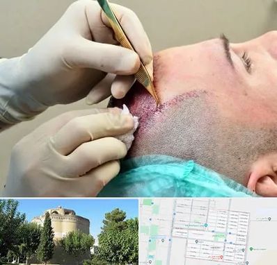 کلینیک کاشت مو در مرداویج اصفهان