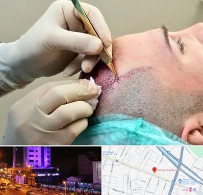 کلینیک کاشت مو در آبرسان تبریز