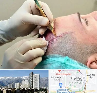 کلینیک کاشت مو در شهرک غرب تهران