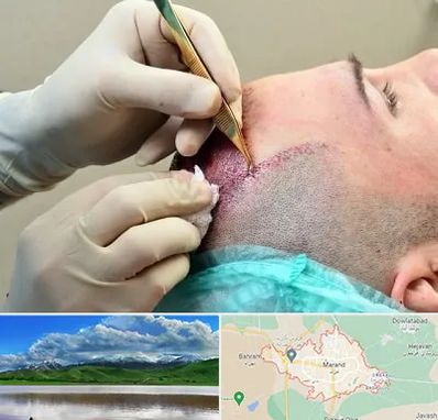 کلینیک کاشت مو در مرند