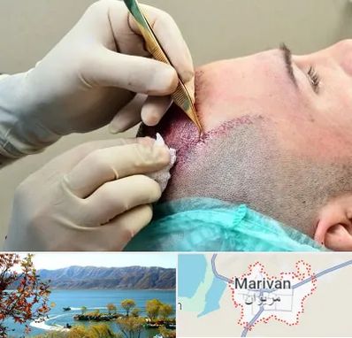کلینیک کاشت مو در مریوان