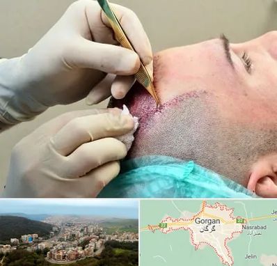 کلینیک کاشت مو در گرگان